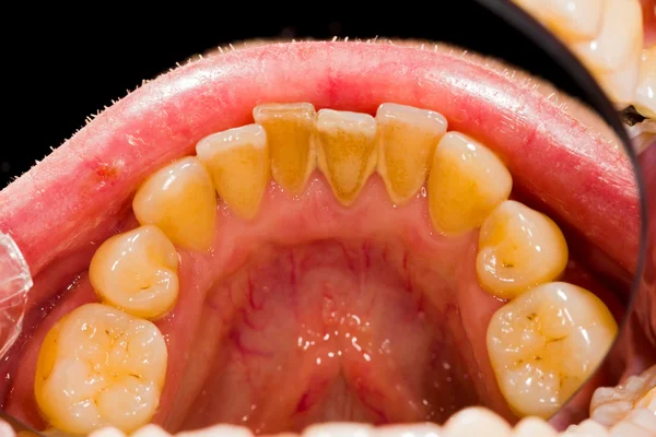 Зубний наліт видалення лікування — стокове фото