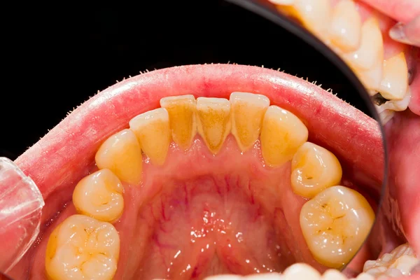 Prótesis dental humana antes de la eliminación de la placa —  Fotos de Stock