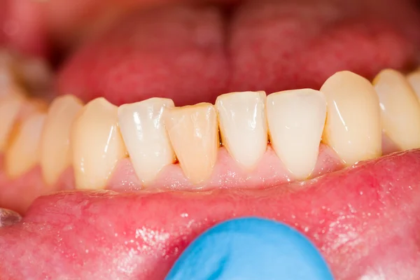 Some healthy teeth of the lower denture — Stock Photo, Image