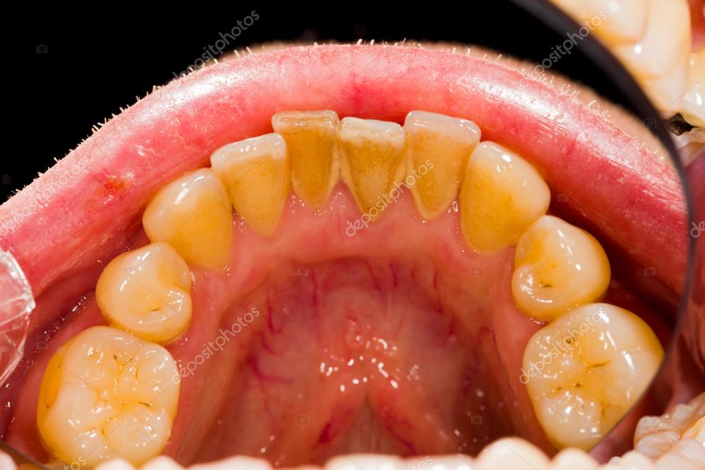 Plaque Removal Treatment Stock Photo by ©Lighthunter 76686943