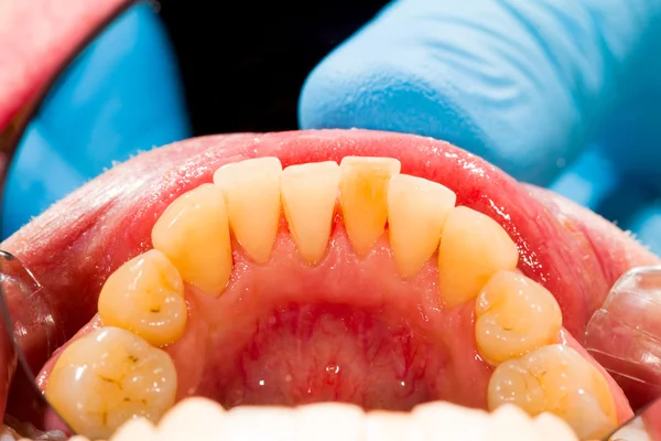 Dentadura sob tratamento de remoção de placas — Fotografia de Stock