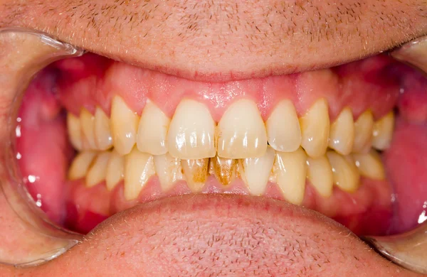 Placca dentale sulla dentiera — Foto Stock