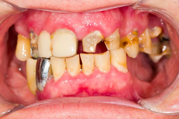 Mund des Patienten vor der gesamten zahnärztlichen Behandlung — Stockfoto