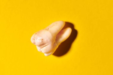 Diş çürüğü olan yirmilik diş, sarı arka plan. Caries 'ten etkilenen üçüncü azı dişi çıkarılmış. Diş eklentileri.