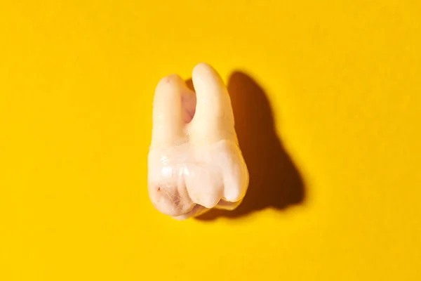 Wisdom tooth with tooth decay, yellow background. Removed third molar affected by caries. Dental extractions.