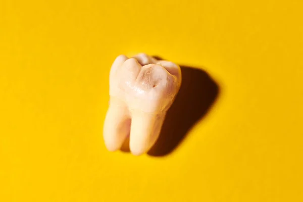 Wisdom tooth with tooth decay, yellow background. Removed third molar affected by caries. Dental extractions.