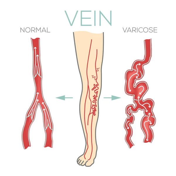 Varicose Veins Large Swollen Vein Legs Feet Valves Work Blood — Stock Photo, Image