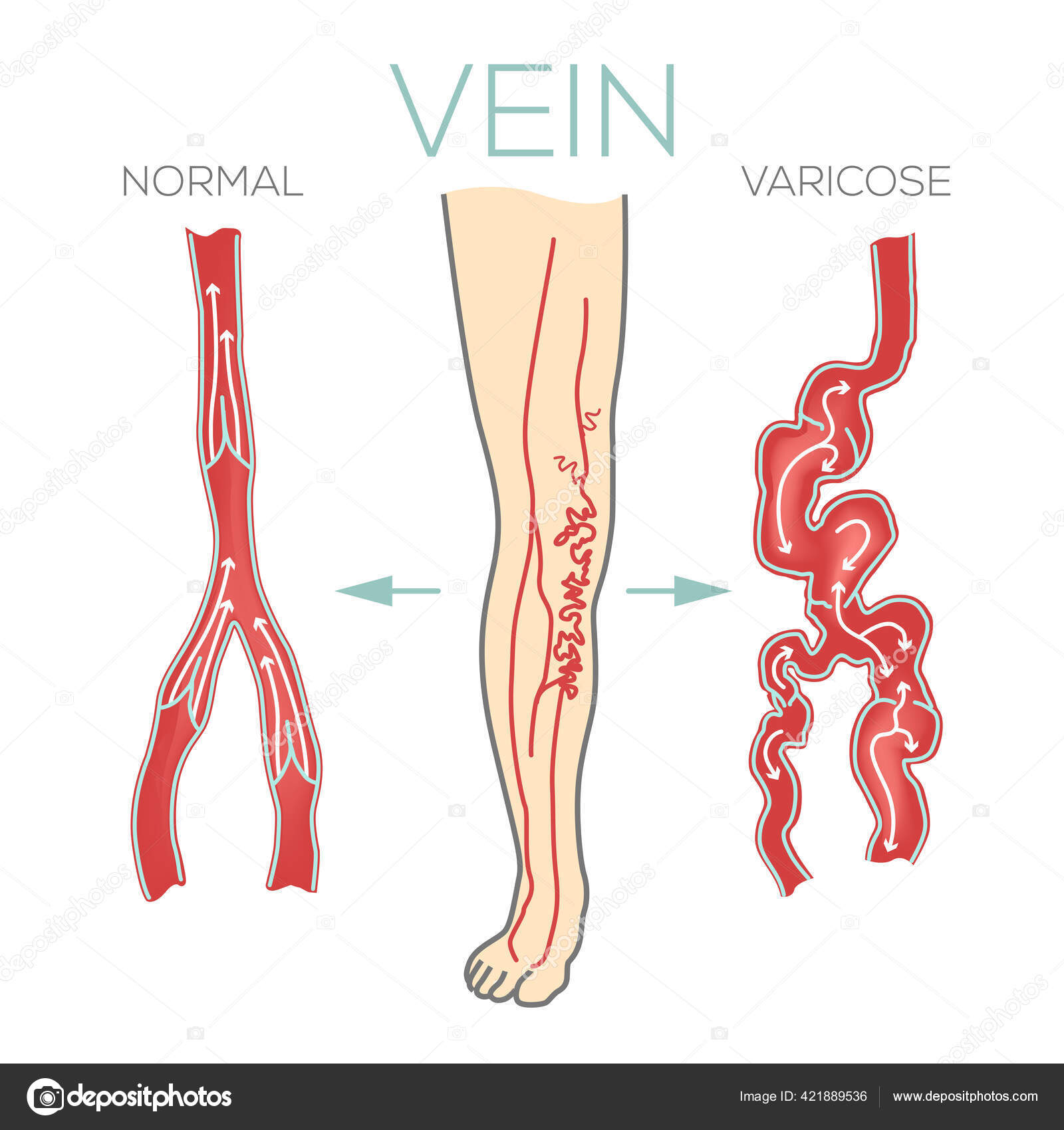 Varicose Veins Large Swollen Vein Legs Feet Valves Work Blood Stock Vector Image by ©Yatakviju