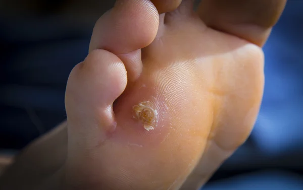 Calluses on foot — Stock Photo, Image