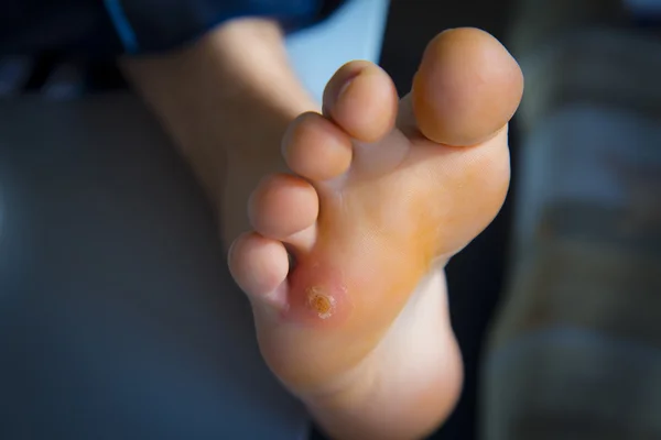 Förhårdnader på foten — Stockfoto