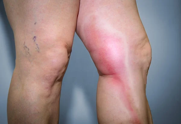 Thrombophlebitis in human leg — Stock Photo, Image