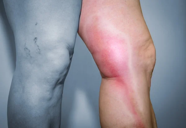 Thrombophlebitis im menschlichen Bein — Stockfoto