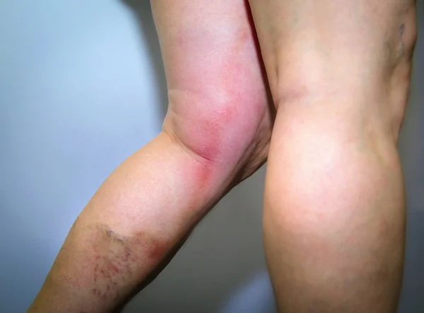 Thrombophlébite dans la jambe humaine — Photo