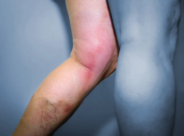 Thrombophlebitis im menschlichen Bein — Stockfoto