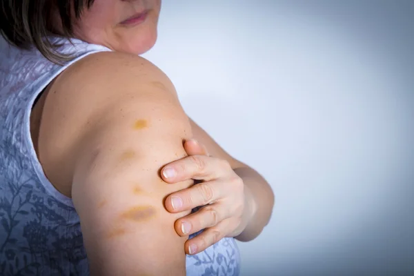 Adult patient showing bruises — Stock Photo, Image