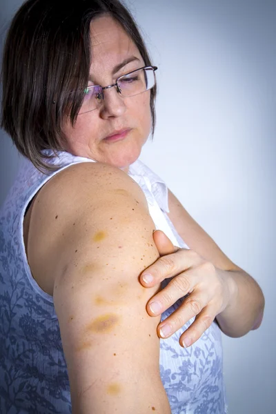 Vuxen patient visar blåmärken — Stockfoto