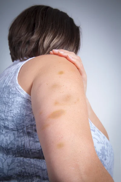 Adult patient showing bruises — Stock Photo, Image