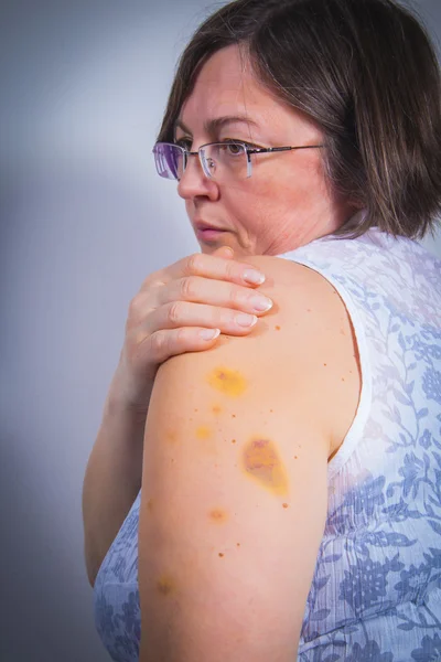 Adult patient showing bruises — Stock Photo, Image