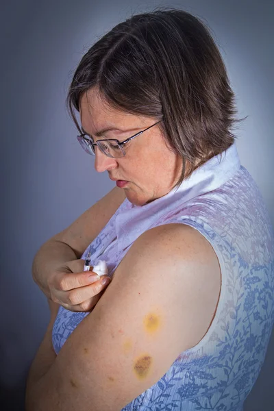 Doente adulto com hematomas — Fotografia de Stock