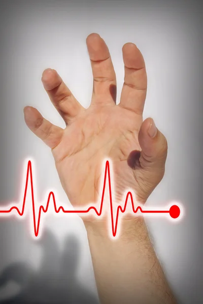 Mão expressando ataque cardíaco - Conceito médico — Fotografia de Stock
