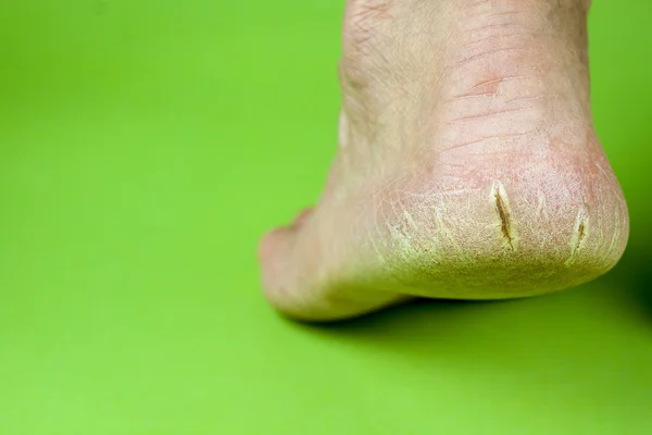 Cracked heel on green background — Stock Photo, Image