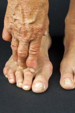 rrheumatoid artrit el ve ayak deformiteleri
