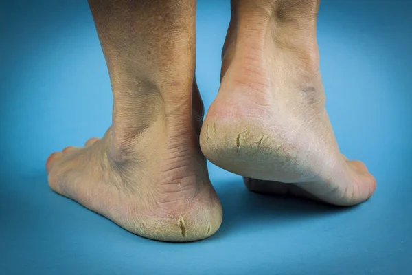 Cracked heels on blue background — Stock Photo, Image