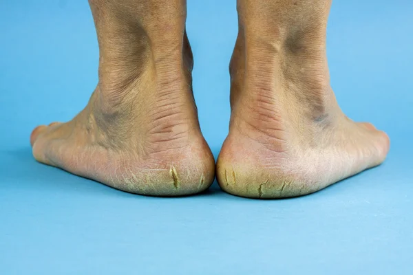 Cracked heels on blue background — Stock Photo, Image