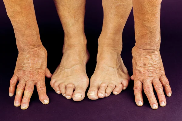Artritis reumatoide deformidades en las manos y los pies — Foto de Stock