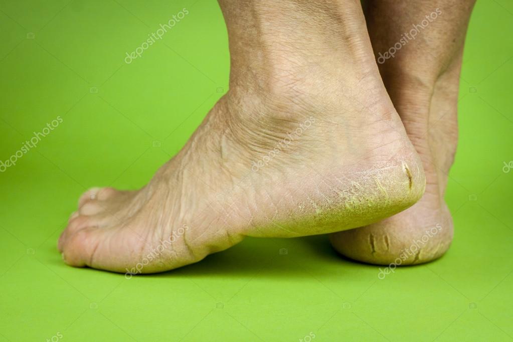 Трещины На Каблуках На Зеленом Фоне Стоковое Фото ©Hriana 54490589