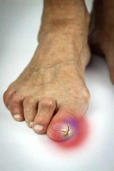 Deformação do dedo do pé rachado e joanete — Fotografia de Stock