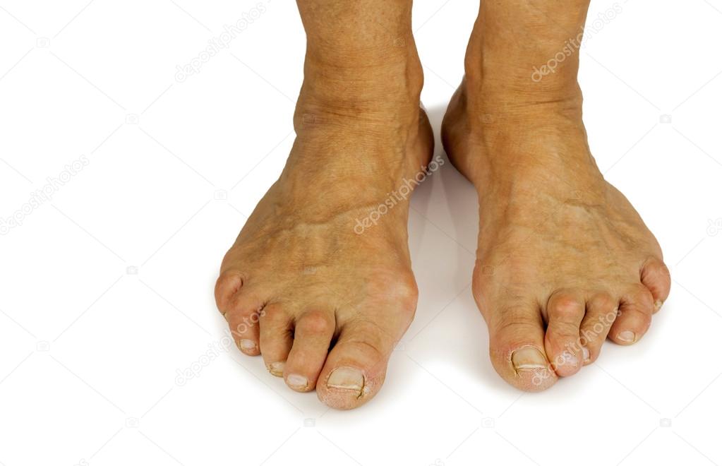 Cracked toe and bunion deformity