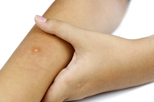 Measles on arm — Stock Photo, Image