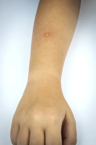 Measles on arm — Stock Photo, Image