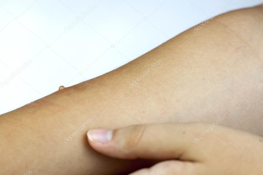 Measles on arm 