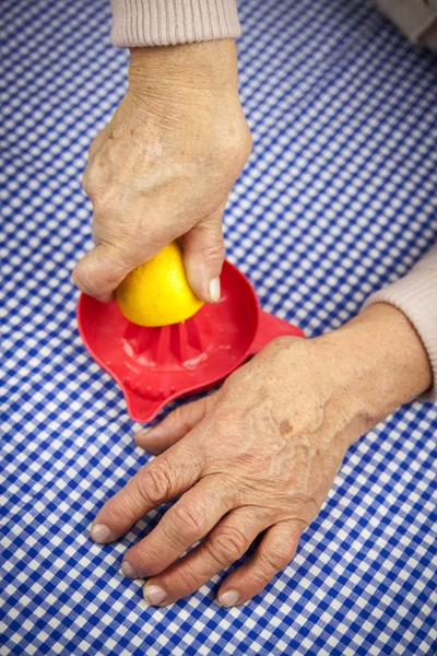 Hände bei rheumatoider Arthritis — Stockfoto