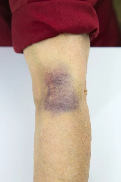 Grande hematoma no braço humano — Fotografia de Stock