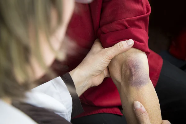 Grote hematoom op menselijke arm — Stockfoto