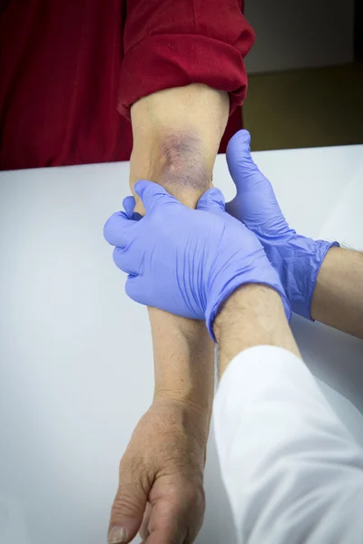 Grande hematoma no braço humano — Fotografia de Stock