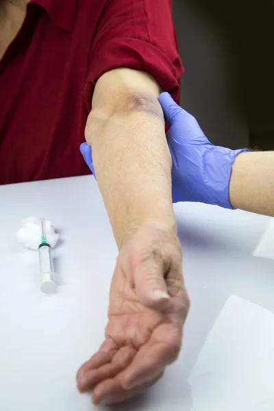 Large hematoma on human arm — Stock Photo, Image