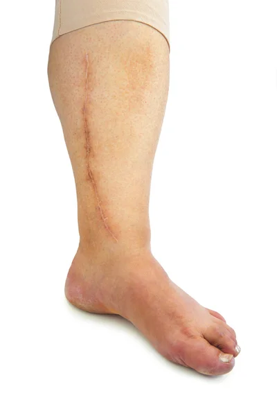 Human leg with postoperative scar of cardiac surgery — Stock Photo, Image