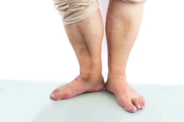 Людська нога з післяопераційним шрамом кардіохірургії — стокове фото