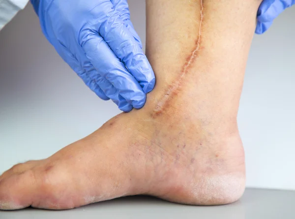 Human leg with postoperative scar of cardiac surgery — Stock Photo, Image