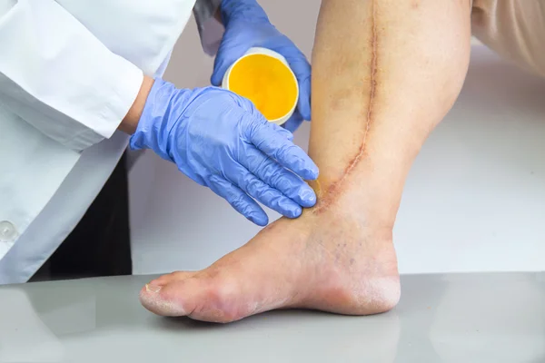 Нога человека со шрамом после операции на сердце — стоковое фото