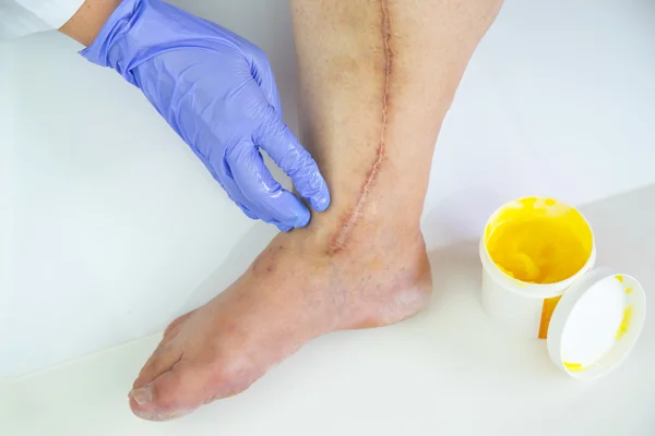 Human leg with postoperative scar of cardiac surgery — Stock Photo, Image