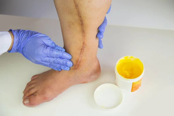 Human leg with postoperative scar of cardiac surgery — Stock Photo, Image