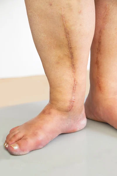 Human leg with postoperative scar of cardiac surgery — Stock Photo, Image