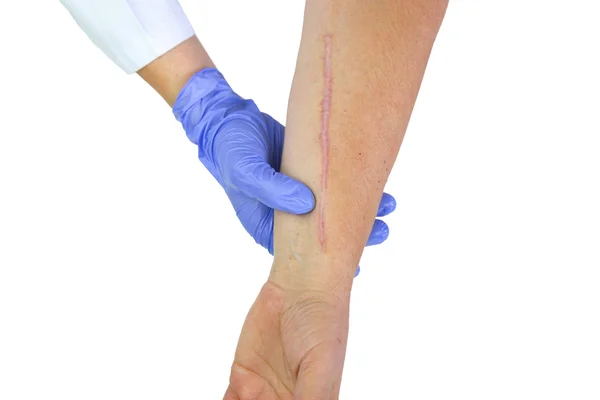 Human arm with postoperative scar of cardiac surgery — Stock Photo, Image
