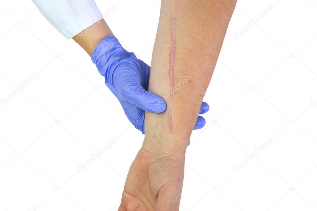 Human arm with postoperative scar of cardiac surgery