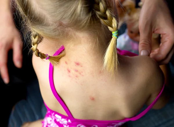 Gyerek allergia vagy a rovarcsípés — Stock Fotó